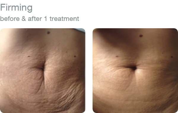 elapromed Adipose Treatment (per session)