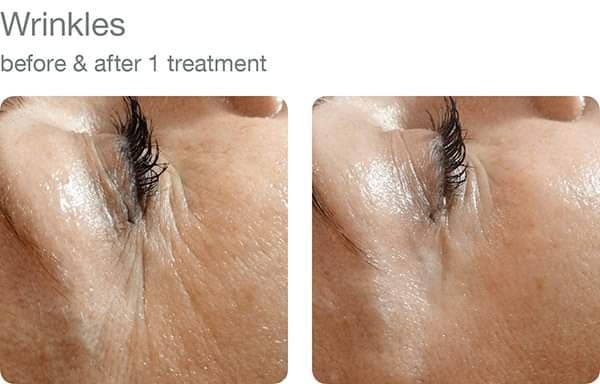 wrinkles before and after treatment